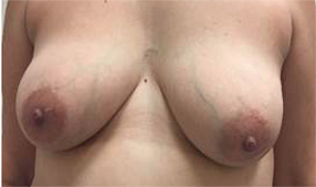 Hidden Scar Lumpectomy Results