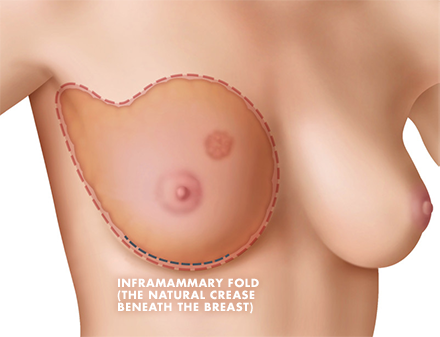 Hidden Scar Mastectomy Diagram