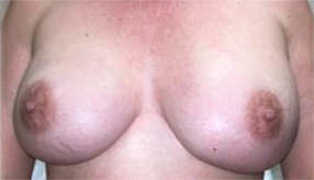 Hidden Scar Mastectomy Results